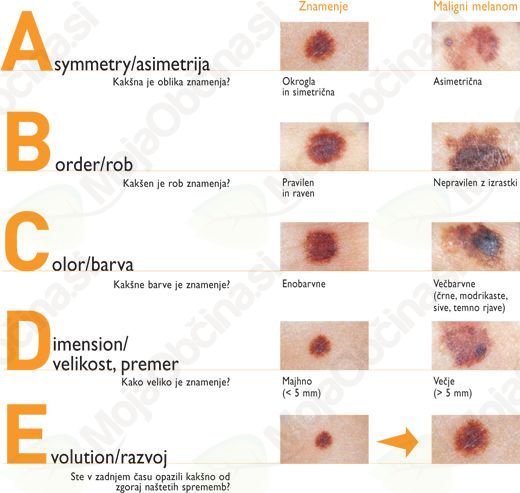 Kožni rak ni samo črna lisa – najpogosteje je trdovratna rana | Občina ...
